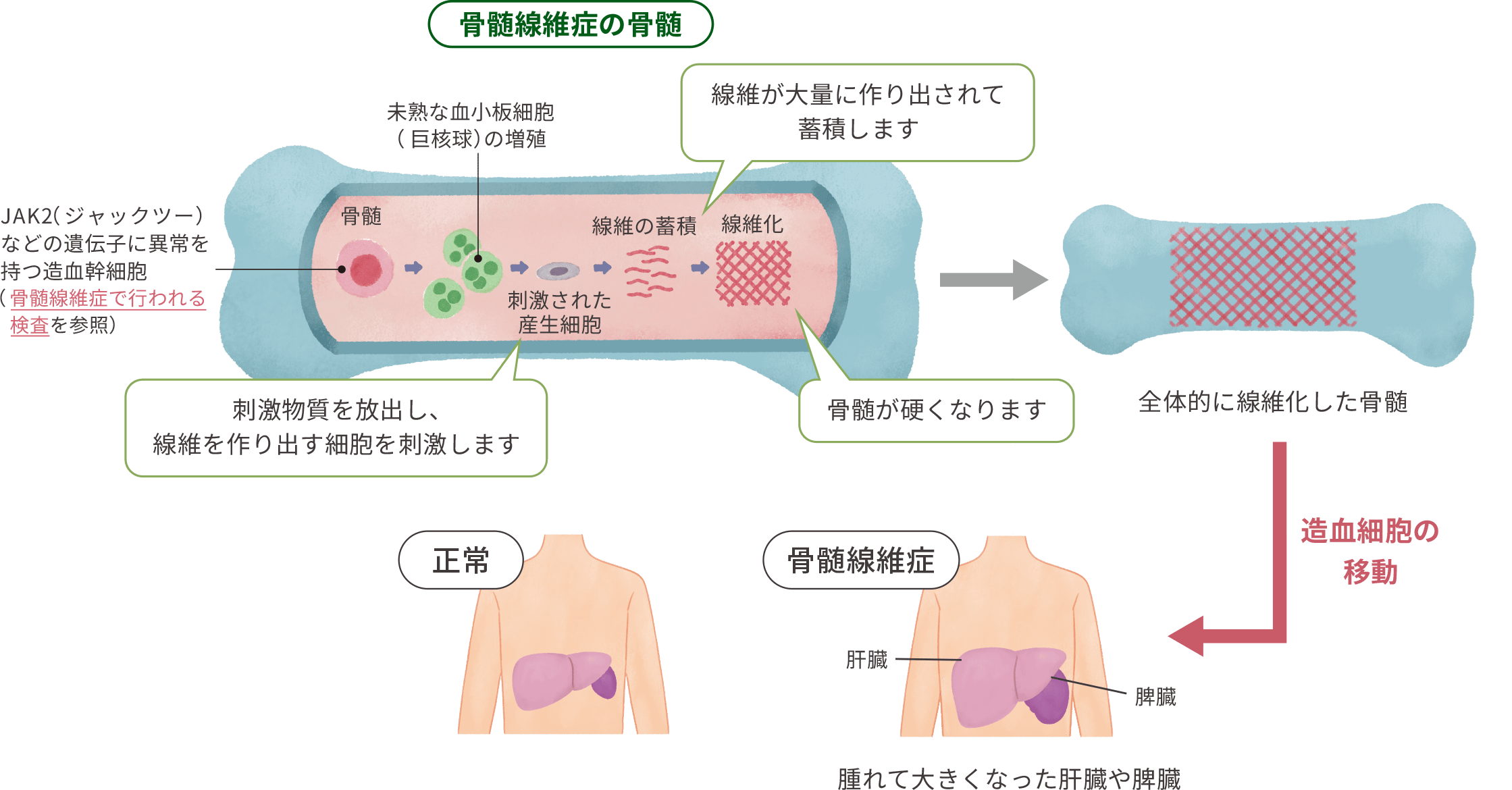骨髄線維症という病気になると・・・のイラスト