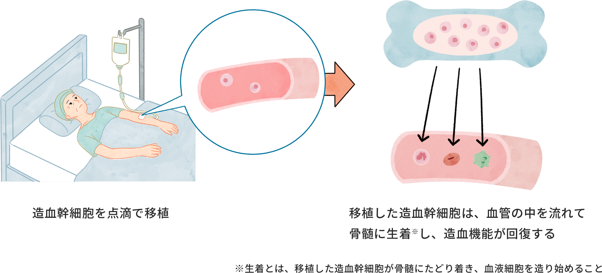 移植（同種造血幹細胞移植）のイラスト